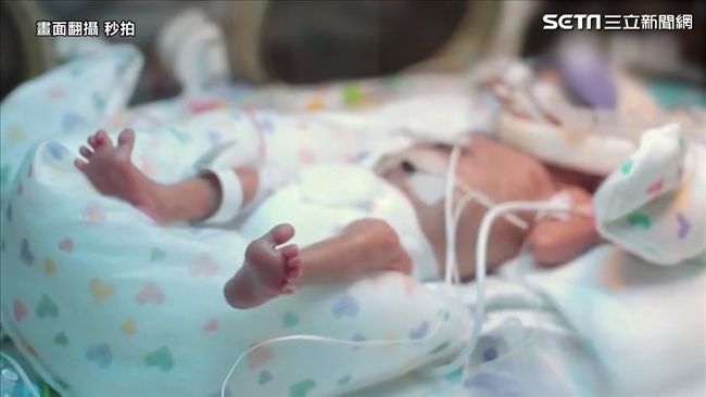 影／巴掌大的早產兒　堅強的活下來