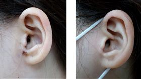 臉歪嘴斜耳流膿 竟是中耳膽脂瘤作怪
北市一名35歲女性多年來左耳流膿，以為是中耳炎，沒
想到最近出現暈眩、臉歪嘴斜等症狀，到萬芳醫院就診
發現原來是中耳膽脂瘤作怪，採耳道微創手術後，成效
良好。
（萬芳醫院提供）
中央社記者梁珮綺