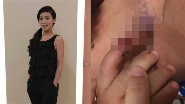 兒遭馬咬斷指　購物專家獲賠75萬