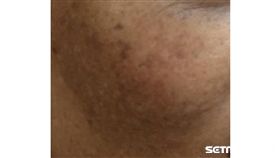 醫師黃雍宗提醒，黑斑以兩頰最常見，由於形狀與顏色與豬肝相似，因此又被稱為肝斑。（圖／醫師黃雍宗提供）