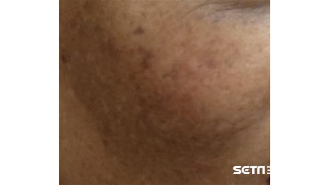 掃墓忘了防曬　當心臉上黏「豬肝」