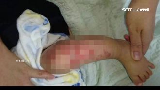 吃喜酒熱湯上桌　8個月嬰被燙到脫皮