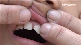 缺牙　牙齒　撞斷牙