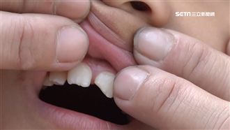 小二童搶球斷牙　索賠20萬終生保固