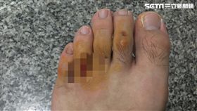 圖／高雄市消防局提供

火燒山暴增！警消疲於奔命吃不消　腳趾破皮潰爛