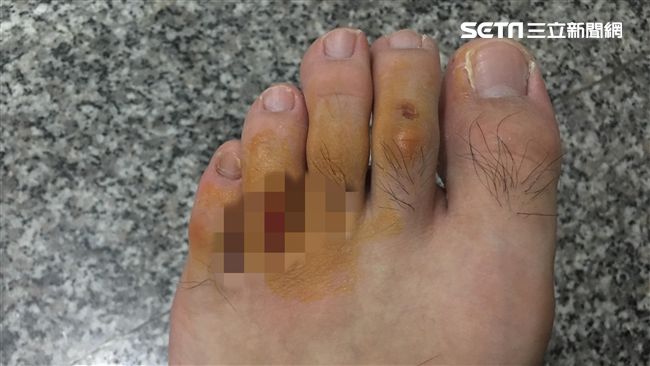 火燒山暴增！消防員疲於奔命腳趾潰爛