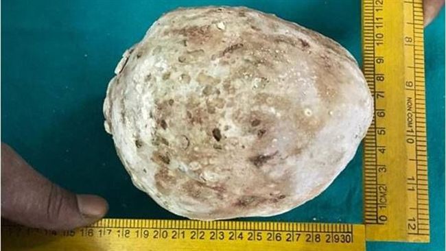 肚子痛…他送醫才發現腹部藏巨大結石