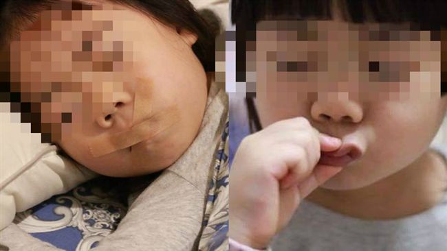 膠帶封口助矯正呼吸？醫師打臉鰻魚媽