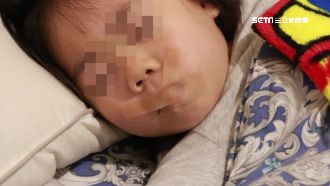 打呼、磨牙要注意　恐成「長臉症」！