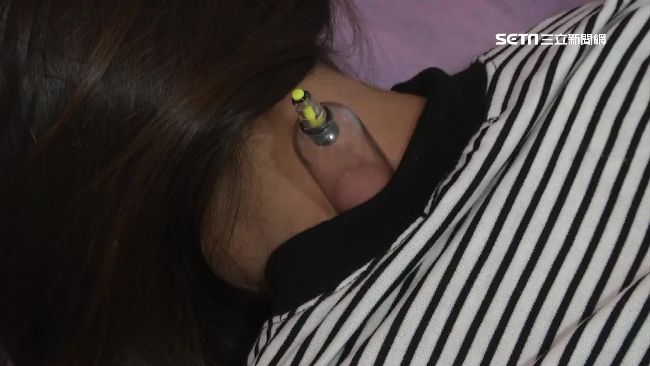 連9天拔罐！陸女背潰爛還昏迷27次