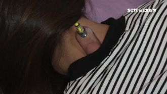 連9天拔罐！陸女背潰爛還昏迷27次