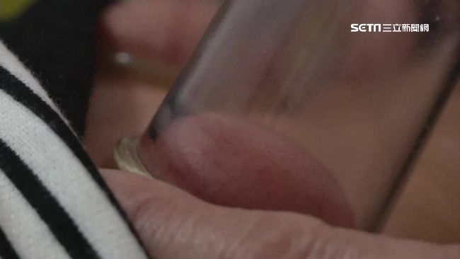 拔罐越深代表體內毒素多？專家解開真相