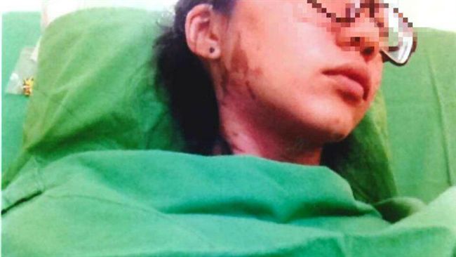 土司工坊打工　女大生端熱油全身燙傷