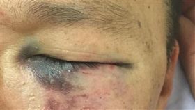 接小孩，遭陌生人狂毆，被害人PO出傷勢照片。