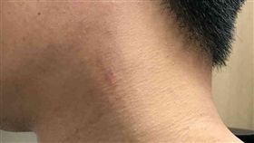 林姓消防員頸部留下抓痕。（圖／翻攝畫面）