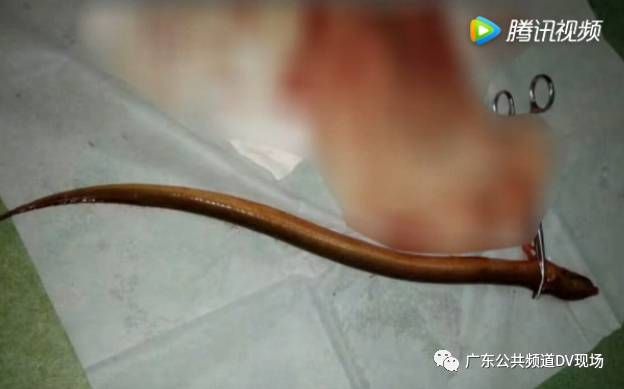 將黃鱔塞肛門　壯漢：牠自己跑進去的