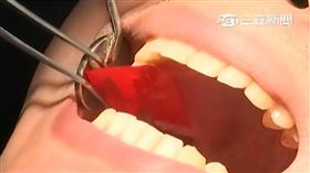 無良牙醫!複寫紙當咬合紙 毒恐下肚