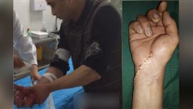 受傷男子到醫院求醫。圖右為他的右手傷口已縫合。（圖／翻攝江蘇網路新聞台）