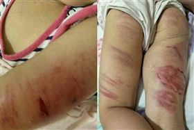4歲女遭狠父拿烤肉夾虐打，「滿是血痕」惹怒網友！(圖/王薇君臉書)