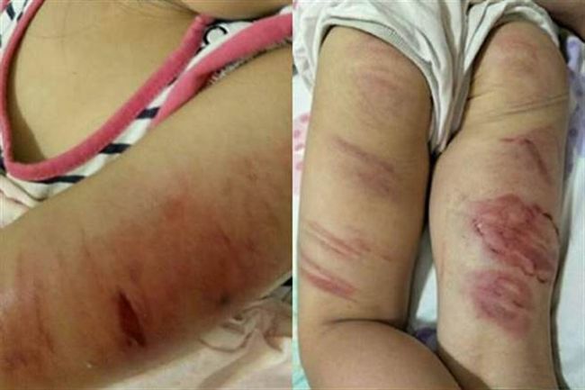 揪心！狠父烤肉鐵夾虐打4歲女