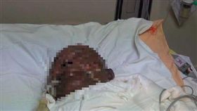 陳錫欣對羅男縱火，羅男燒後滿臉焦黑，奄奄一息。翻攝照片