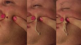 痘痘4年未消…用力一擠竟像「瀑布」洩洪　網友：好療癒
圖／擷取自每日郵報