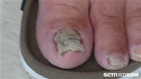 53歲的溫女士以為自己罹患灰指甲，擦藥3個月後無效，就醫診治竟是鉗狀指甲惹禍。（圖／記者楊晴雯攝）