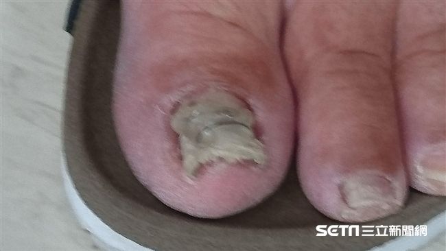 腳趾甲捲又厚　是這病惹禍誤當灰指甲