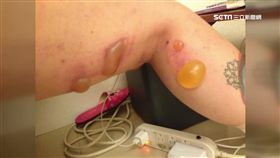 \砸77萬抽脂! 妙齡女二度燙傷起大水泡