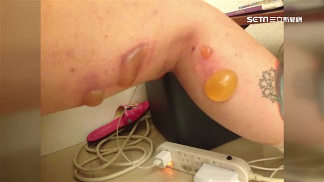 砸80萬整型！妙齡女大腿燙傷起水泡