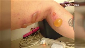 砸80萬整型！妙齡女大腿燙傷起水泡