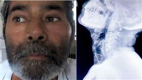 16:9
被外星人抓走？印男體內有75根針　哪來的本人完全不知道
圖／翻攝自鏡報
http://www.mirror.co.uk/news/world-news/patient-leaves-doctors-stumped-after-10334813