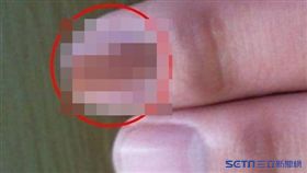 他指甲埋「黑彩虹」　不痛不癢竟是～