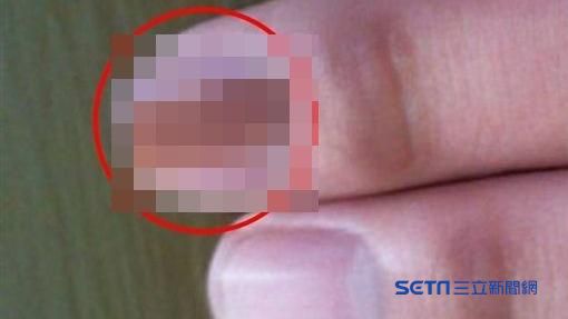 指甲出現黑線…他拖5年檢查驚是癌王