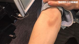 獨／館長這一踢...熱血記者牙缺角