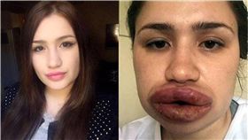 嘴唇,豐唇,整形,整容,土耳其,Merve Keles　圖／翻攝自Gazete Türkiye 臉書