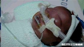 一月大女娃因家人感染百日咳遭傳染，到院時發燒、臉發黑，所幸經積極治療40天後順利出院。（圖／馬偕兒童醫院醫務部主任邱南昌提供）