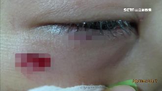 遭同學墊板打傷　小六男童右眼恐失明