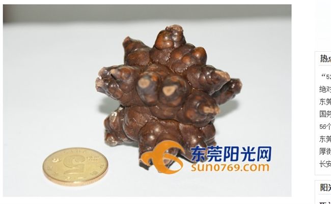 老翁結石長相太奇怪　家屬竟想收藏