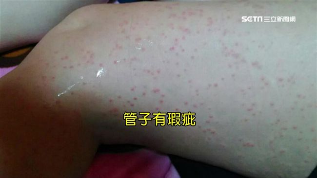 全身紅點上百顆！驚爆科技廠毒害員工