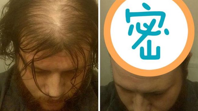 擺脫禿頭！他靠「這招」一秒變型男