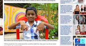 印度蹼指（圖／翻攝自Daily Mail）
http://www.dailymail.co.uk/health/article-4510396/Indian-family-refuse-surgery-webbed-hands.html