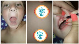 指甲卡牙床（合成圖／翻攝自YouTube）