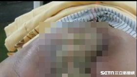 醫師吳元宏臉書貼文分享，一位直腸癌病患因使用偏方治療延誤病情不幸喪命的案例。（圖／擷取自吳元宏臉書）