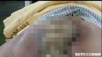 棄正規治療　腸癌男腫瘤衝破肛門丟命