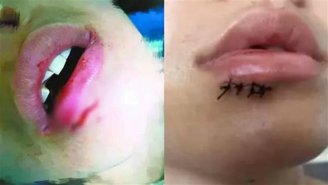 IKEA杯子突爆炸　陸女當場被炸暈
