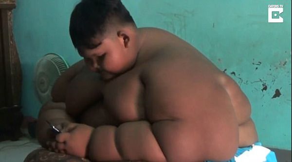 印尼11歲男童　過胖被迫切胃15%