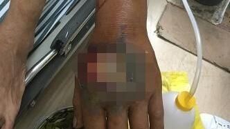 看雨傘節有毒否　他手滑遭毒牙刺中…