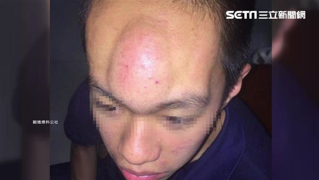 輸牌彈200下額頭　男竟腫成羅漢魚