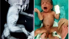 印度,寄身,雙胞胎,腿,愛,治療,手術,每日郵報